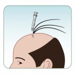 زراعة الشعر و عمليات التجميل في اسطنبول